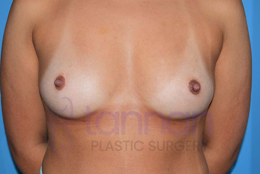 Inverted-Nipple-after-0101-Tannan-Plastic-Surgery