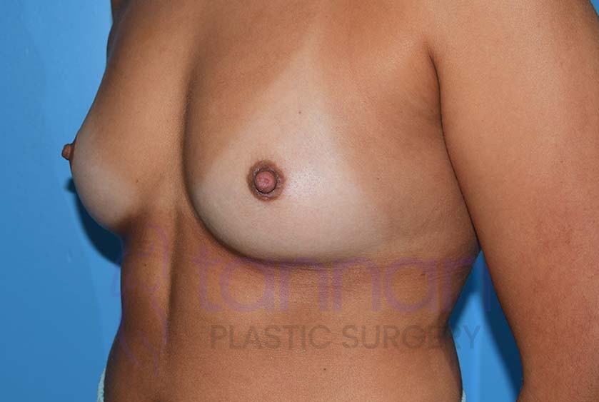 Inverted-Nipple-after-0102-Tannan-Plastic-Surgery