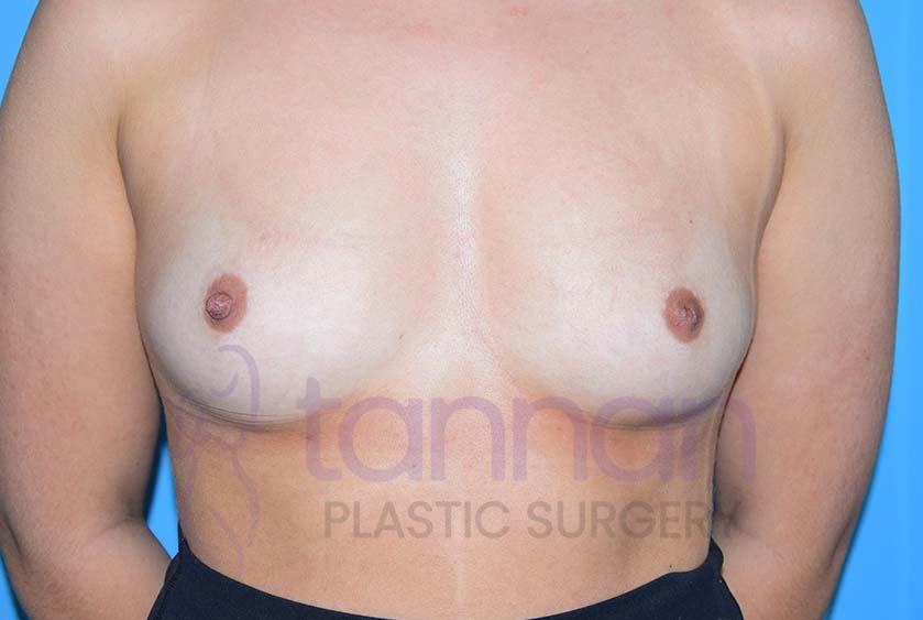 Inverted-Nipple-before-0101-Tannan-Plastic-Surgery