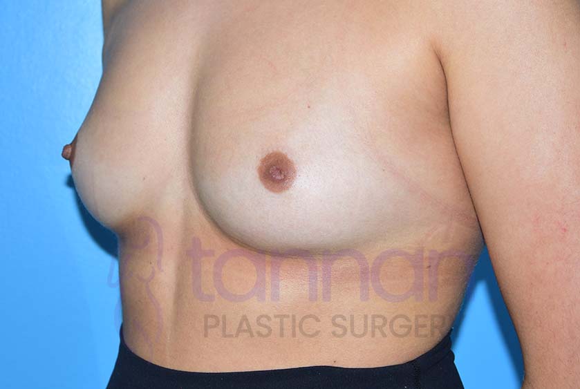 Inverted-Nipple-before-0102-Tannan-Plastic-Surgery