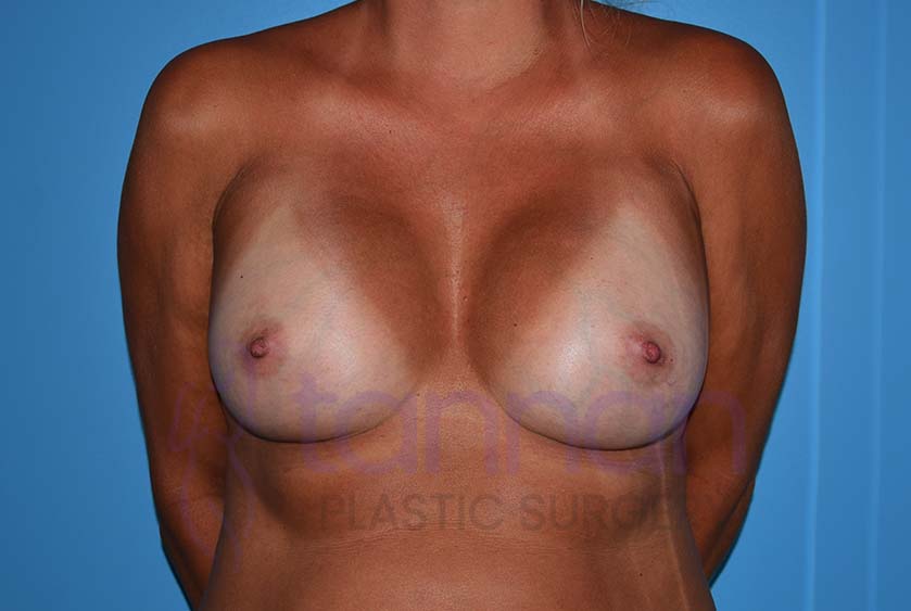 Breast-Augmentation-After-5801-Tannan-Plastic-Surgery