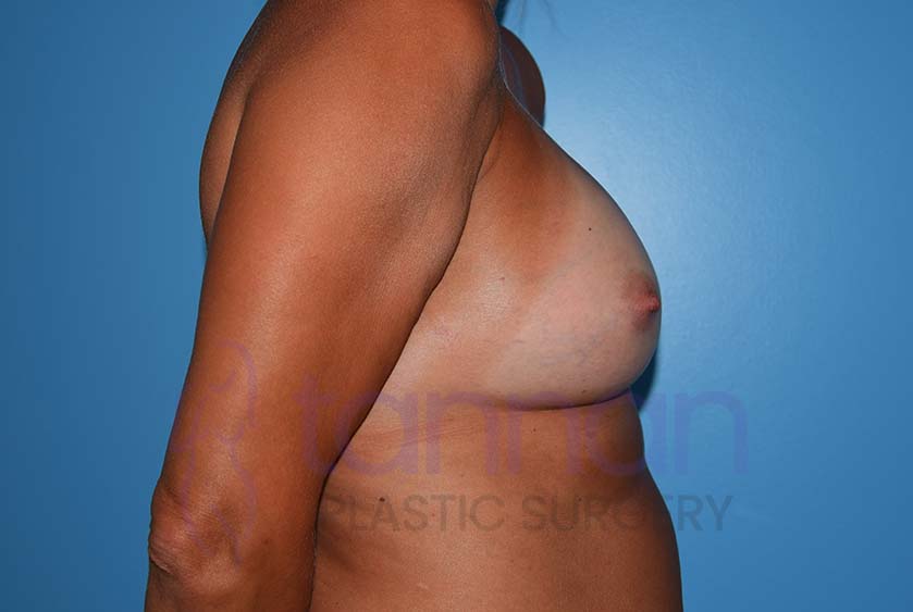 Breast-Augmentation-After-5802-Tannan-Plastic-Surgery
