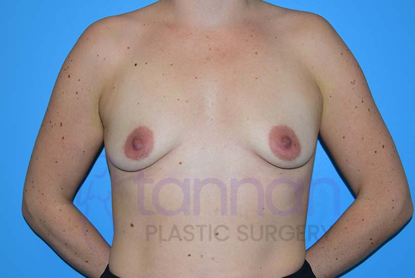 Breast-Augmentation-Before-5402-Tannan-Plastic-Surgery