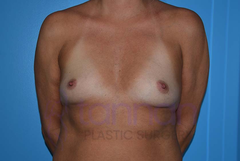 Breast-Augmentation-Before-5801-Tannan-Plastic-Surgery