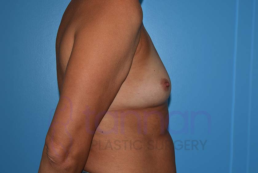 Breast-Augmentation-Before-5802-Tannan-Plastic-Surgery