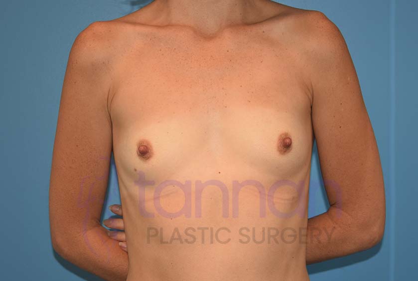 Breast-Augmentation-Before-5901-Tannan-Plastic-Surgery