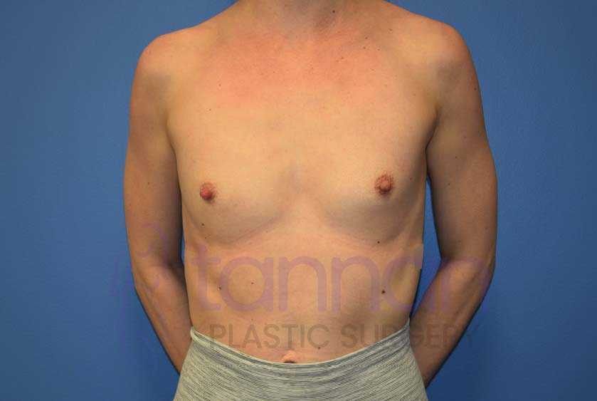 Breast-Augmentation-Before-6101-Tannan-Plastic-Surgery