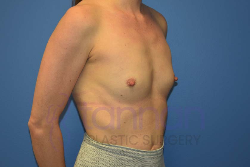 Breast-Augmentation-Before-6102-Tannan-Plastic-Surgery