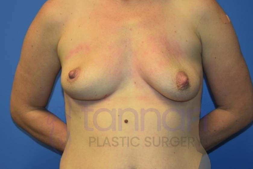 Breast-Augmentation-Before-6201-Tannan-Plastic-Surgery