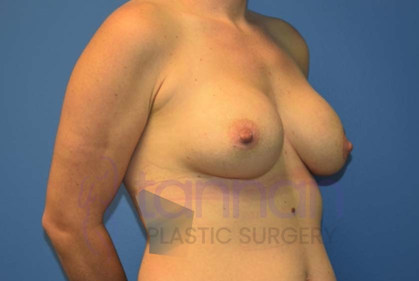 Breast-Augmentation-Before-6202-Tannan-Plastic-Surgery