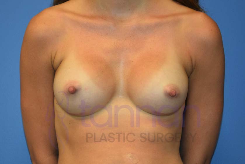 Breast-Augmentation-After-6401-Tannan-Plastic-Surgery