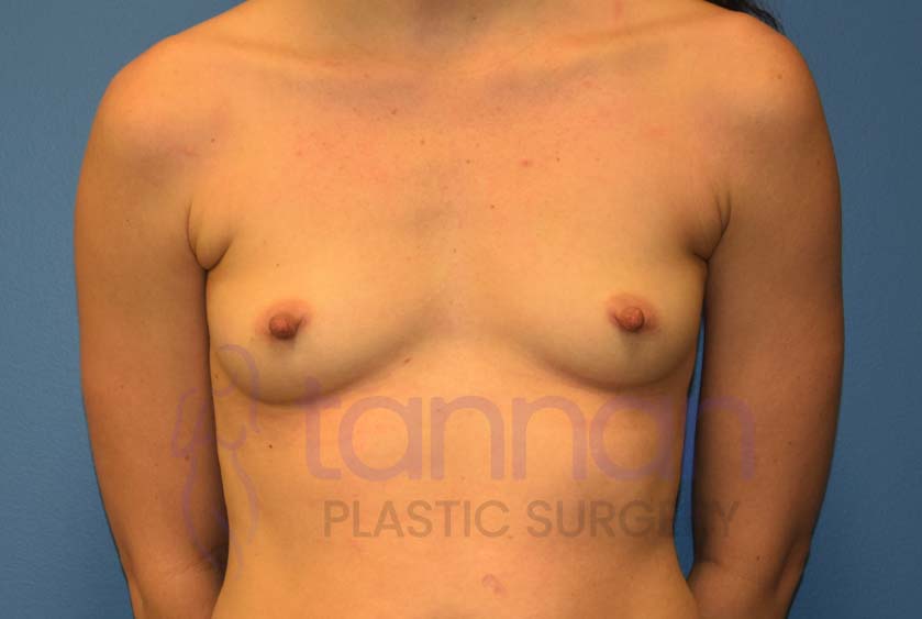 Breast-Augmentation-Before-6401-Tannan-Plastic-Surgery