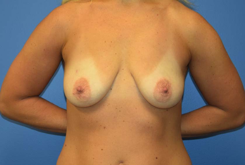 Breast-Augmentation-Before-6501-Tannan-Plastic-Surgery
