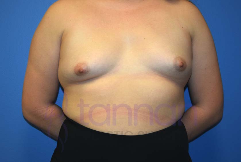 Breast-Augmentation-Before-6701-Tannan-Plastic-Surgery