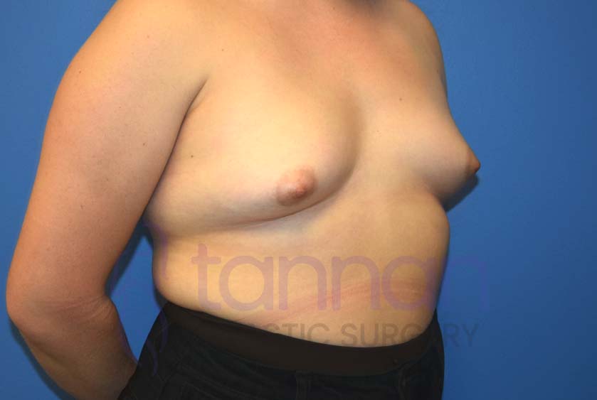 Breast-Augmentation-Before-6702-Tannan-Plastic-Surgery