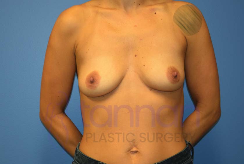 Breast-Augmentation-Before-6801-Tannan-Plastic-Surgery