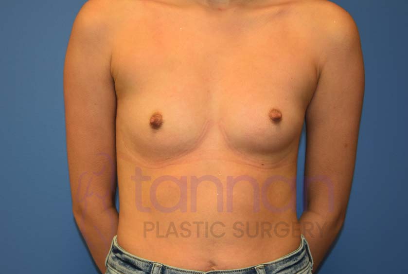 Breast-Augmentation-Before-6901-Tannan-Plastic-Surgery
