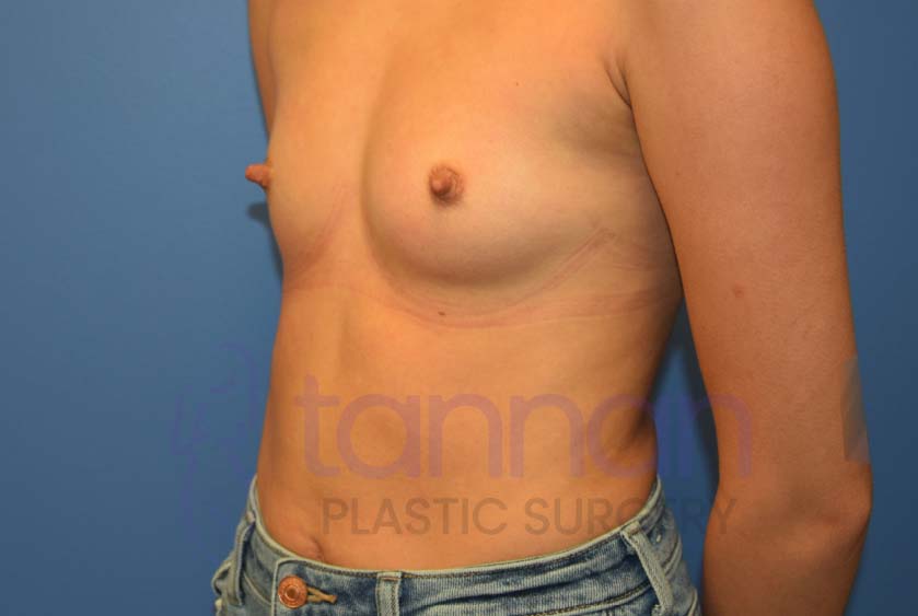 Breast-Augmentation-Before-6902-Tannan-Plastic-Surgery
