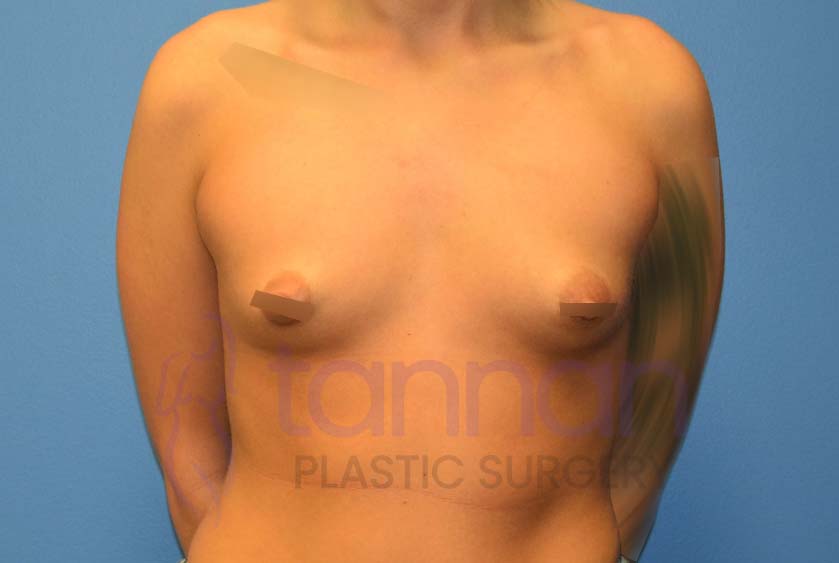 Breast-Augmentation-Before-7001-Tannan-Plastic-Surgery