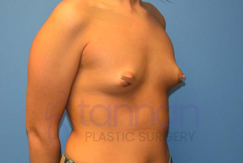 Breast-Augmentation-Before-7002-Tannan-Plastic-Surgery