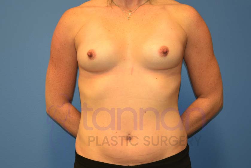 Breast-Augmentation-Before-7101-Tannan-Plastic-Surgery