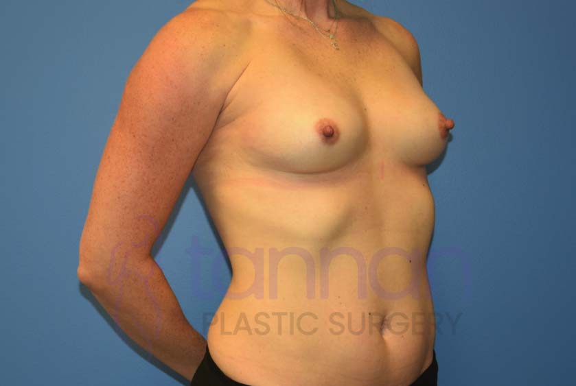 Breast-Augmentation-Before-7102-Tannan-Plastic-Surgery