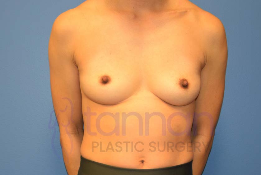 Breast-Augmentation-Before-7201-Tannan-Plastic-Surgery