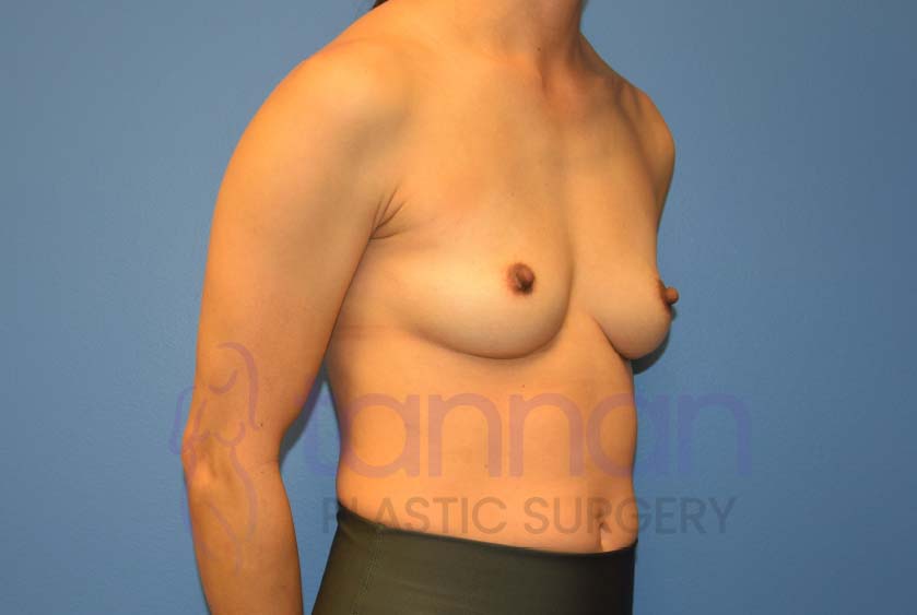 Breast-Augmentation-Before-7202-Tannan-Plastic-Surgery