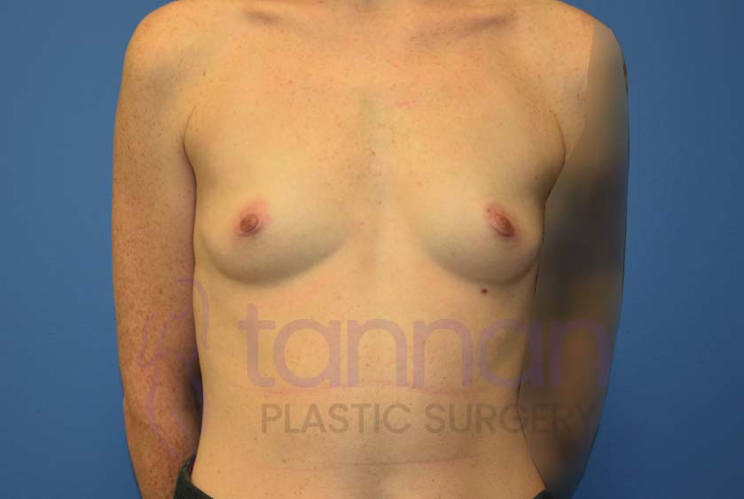 Breast-Augmentation-Before-7301-Tannan-Plastic-Surgery