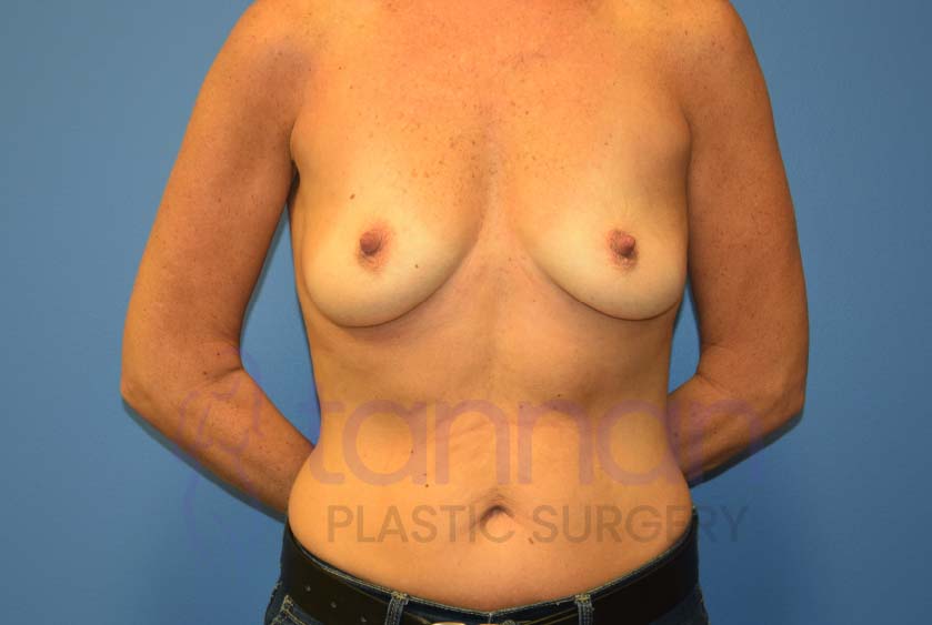Breast-Augmentation-Before-7401-Tannan-Plastic-Surgery