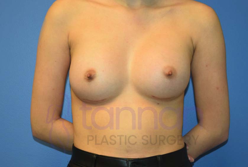 Breast-Augmentation-after-6901-Tannan-Plastic-Surgery