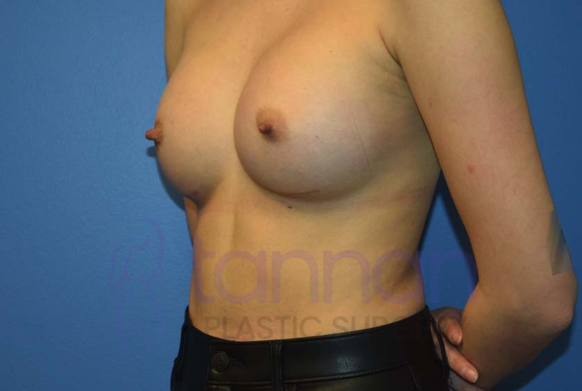 Breast-Augmentation-after-6902-Tannan-Plastic-Surgery