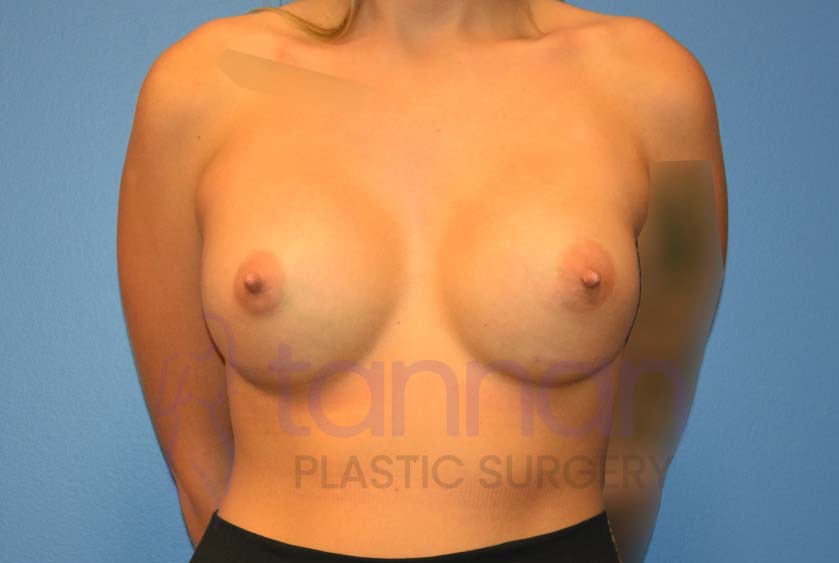 Breast-Augmentation-after-7001-Tannan-Plastic-Surgery