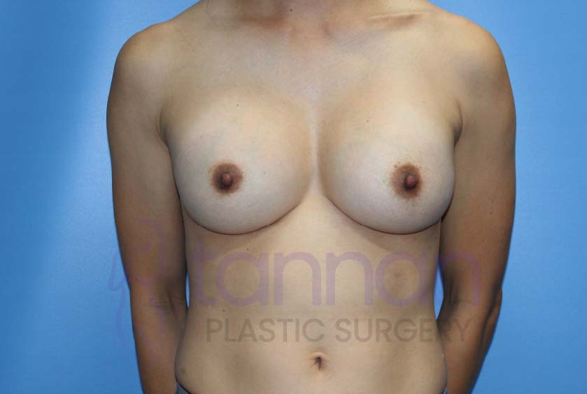 Breast-Augmentation-after-7201-Tannan-Plastic-Surgery