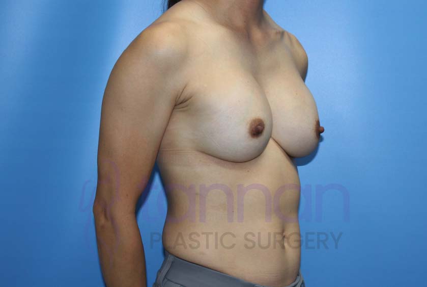 Breast-Augmentation-after-7202-Tannan-Plastic-Surgery