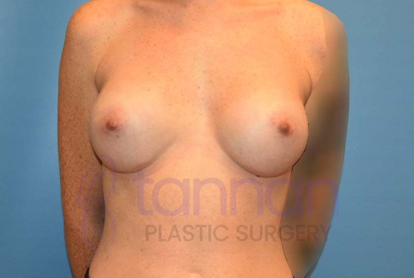 Breast-Augmentation-after-7301-Tannan-Plastic-Surgery