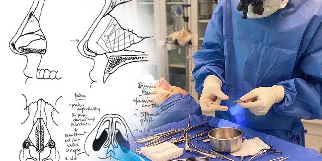 revision-rhinoplasty-Tannan-Plastic-Surgery behind the scenes with revision rhinoplasty