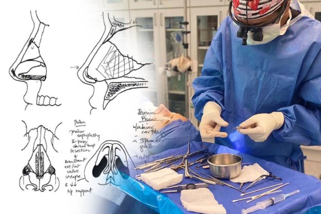 behind the scenes with revision rhinoplasty