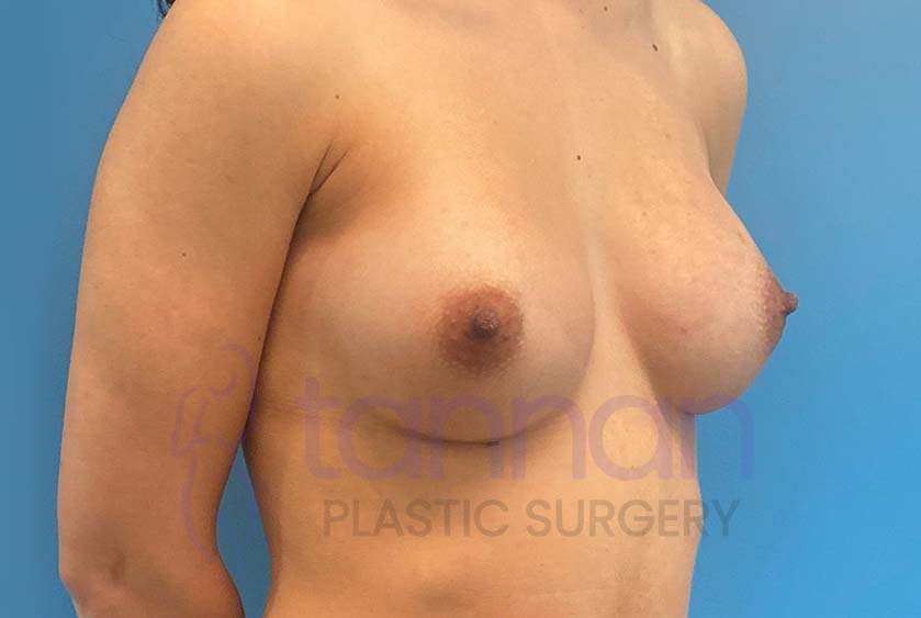 Breast-Augmentation-After-6602-Tannan-Plastic-Surgery
