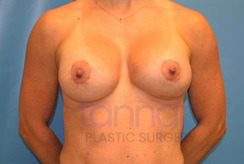Breast-Augmentation-After-7701-Tannan-Plastic-Surgery