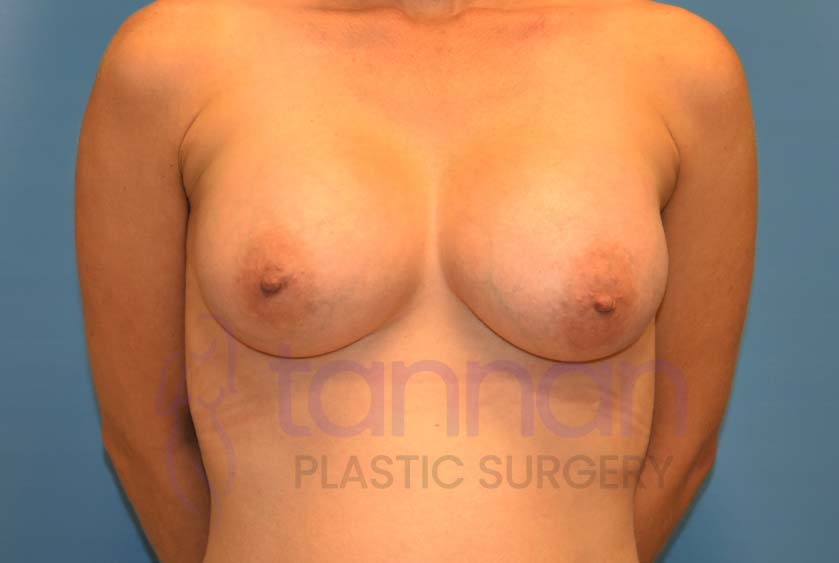 Breast-Augmentation-Aftere-7601-Tannan-Plastic-Surgery