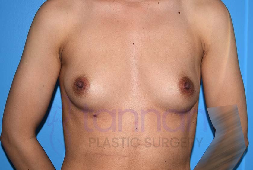 Breast-Augmentation-Before-6601-Tannan-Plastic-Surgery