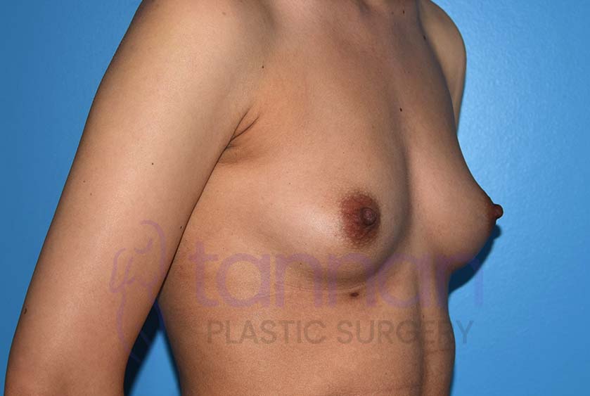 Breast-Augmentation-Before-6602-Tannan-Plastic-Surgery