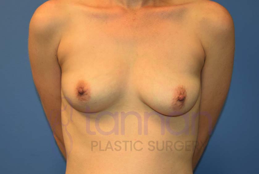 Breast-Augmentation-Before-7601-Tannan-Plastic-Surgery