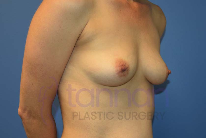 Breast-Augmentation-Before-7602-Tannan-Plastic-Surgery