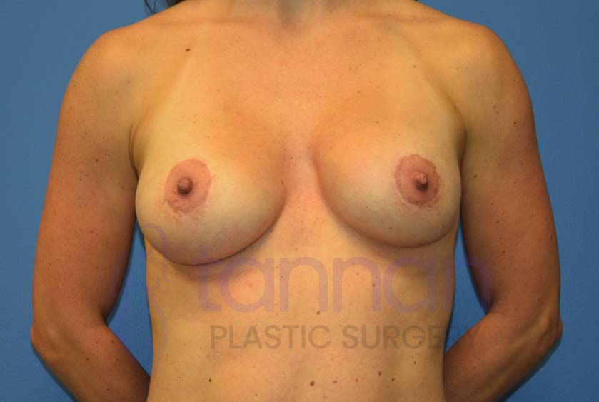 Breast-Augmentation-Before-7701-Tannan-Plastic-Surgery
