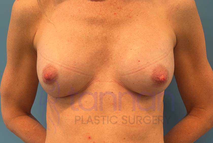 Breast-Augmentation-After-7801-Tannan-Plastic-Surgery