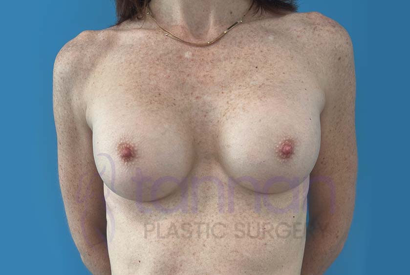 Breast-Augmentation-After-8001-Tannan-Plastic-Surgery
