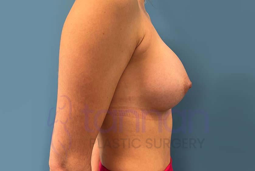 Breast-Augmentation-After-8202-Tannan-Plastic-Surgery