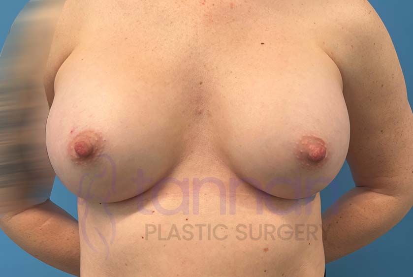 Breast-Augmentation-Aftere-8401-Tannan-Plastic-Surgery